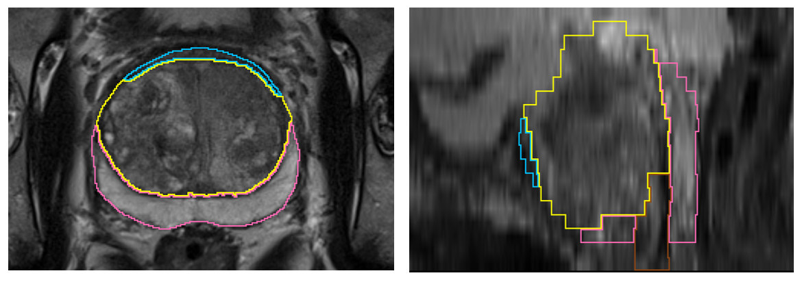 Example case in axial and sagittal view with corresponding zone segmentation. The 4-class segmentation consists of peripheral zone (pink), transitional zone (yellow), anterior fibromuscular stroma (blue)  and distal prostatic urethra (brown)