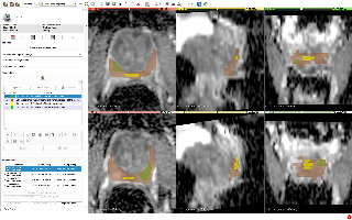 QIN-Prostate-Repeatability 3D-Slicer image