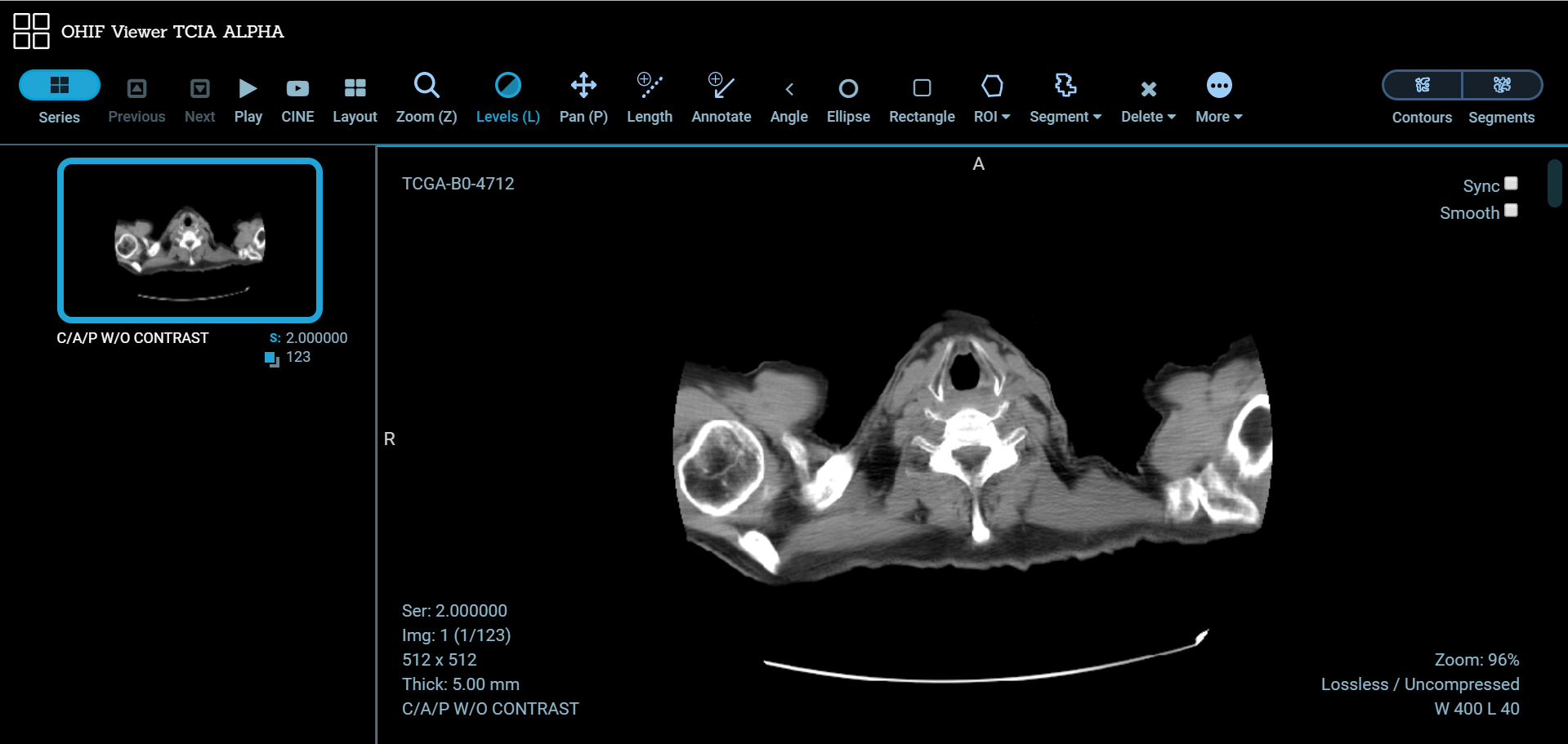 OHIF Viewer TCIA Alpha showing a toolbar, an overview image, and a large, main image window.