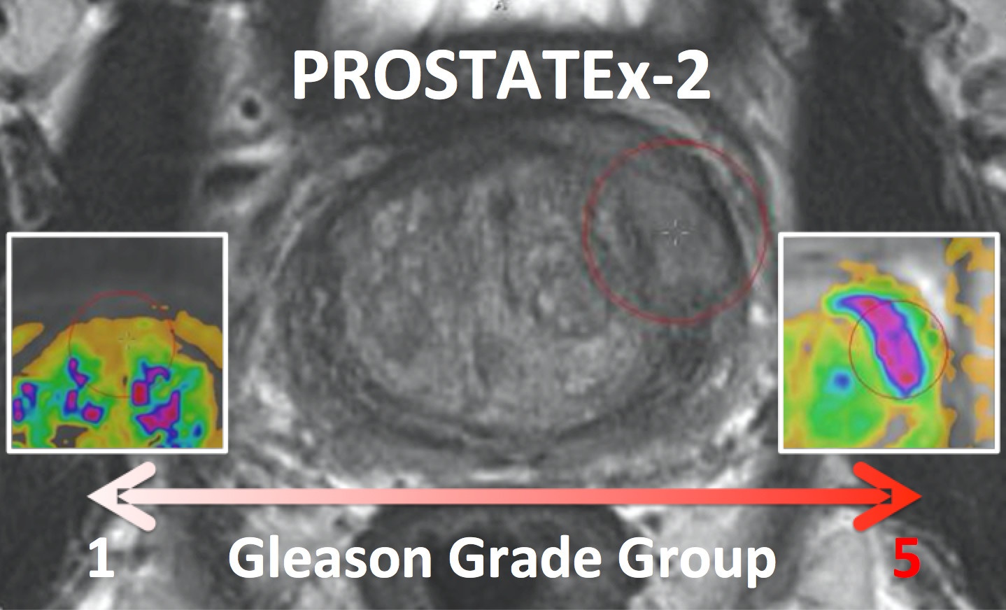 k prostate gleason 3 4 descarga k prostate gleason 3 4 descarga