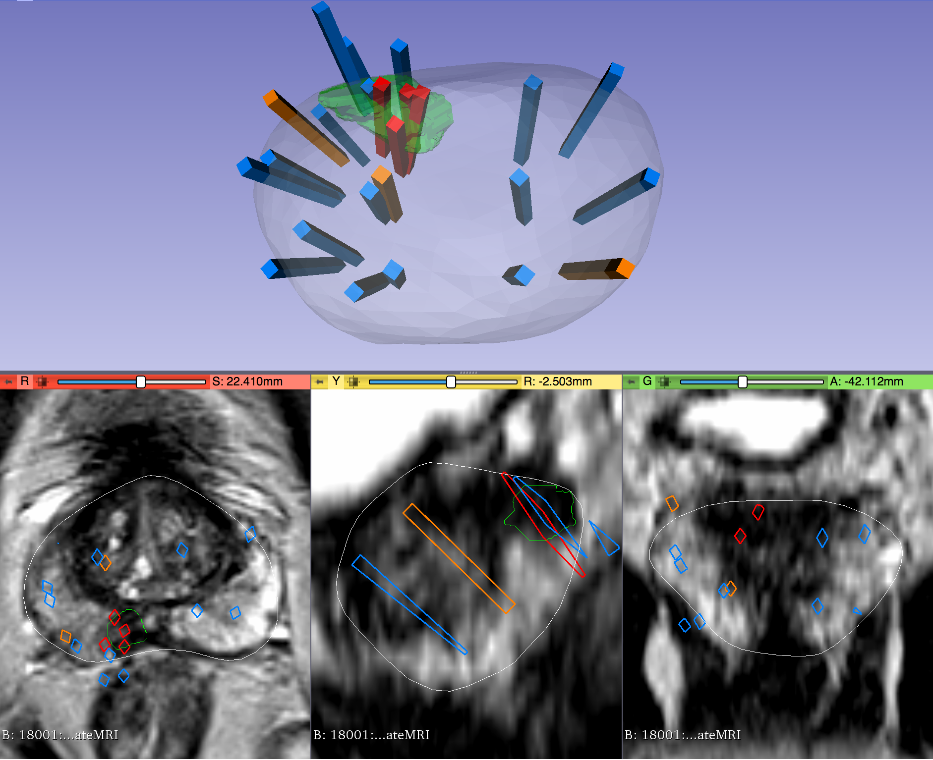 The Cancer Imaging Archive (TCIA) Public Access > Prostate MRI and Ultrasound With Pathology and Coordinates of Tracked Biopsy (Prostate-MRI-US-Biopsy) > Prostate-MRI-US-Biopsy-Exemplary Image (Complex).png (These two images show biopsy data displayed in 3D alongside MRI contours. The image on the left captures the entire 3D slicer screen. The image on the right succinctly exemplifies most aspects of the dataset. )