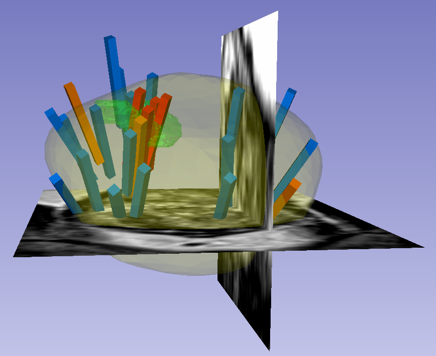 These two images show biopsy data displayed in 3D alongside MRI contours. The image on the left captures the entire 3D slicer screen.  The image on the right succinctly exemplifies most aspects of the dataset.