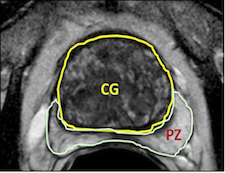 The Cancer Imaging Archive (TCIA) Public Access > NCI-ISBI 2013 Challenge - Automated Segmentation of Prostate Structures > prostate-seg.PNG
