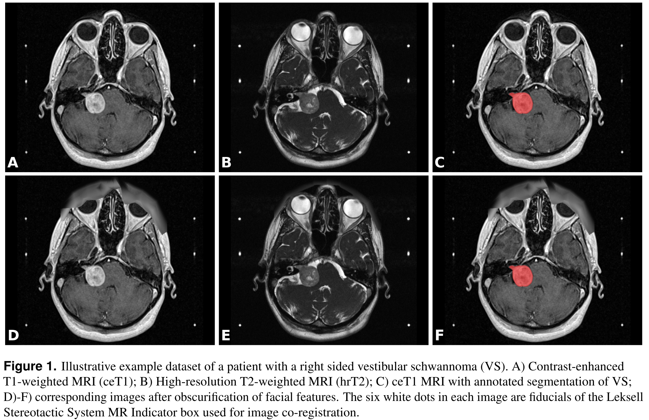 Segmentation of Vestibular Schwannoma from Magnetic Resonance Imaging: An Open Annotated Dataset and Baseline Algorithm (Vestibular-Schwannoma-SEG) - The Cancer Imaging Archive (TCIA) Access Cancer Imaging Archive Wiki