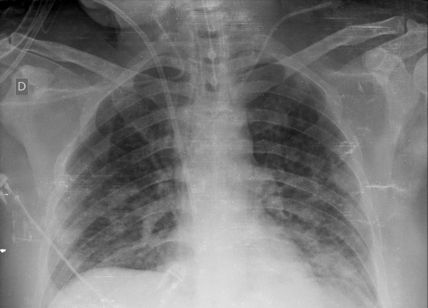 Covid 19 Chest X-Ray